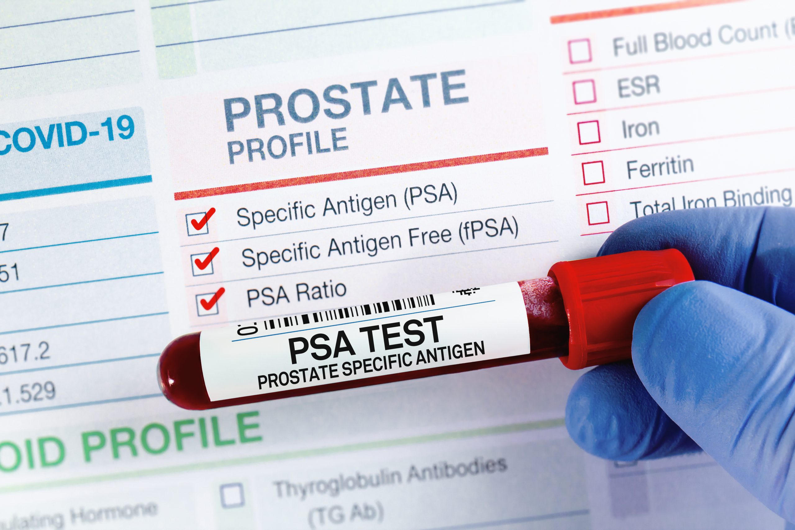 psa-test-biomarcador-prostata